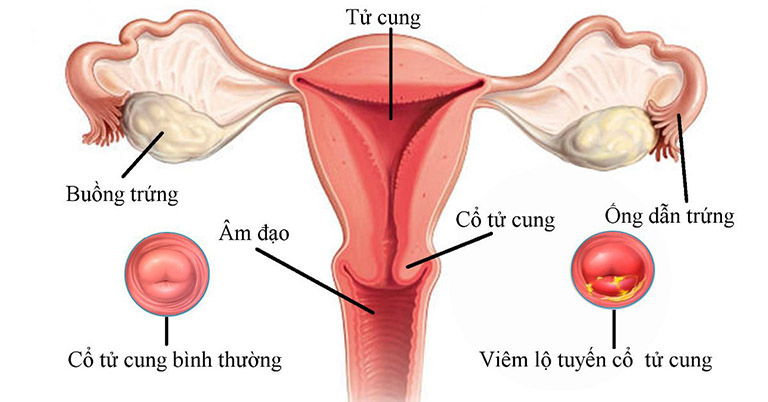 Viêm lộ tuyến cổ tử cung