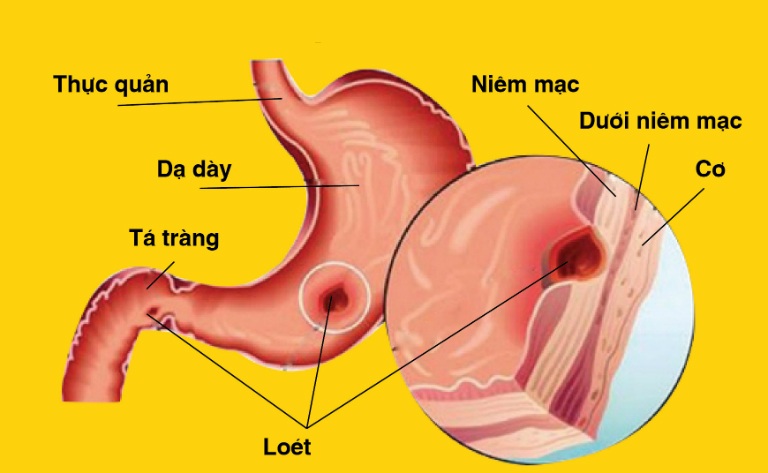 Triệu chứng khi bị viêm loét