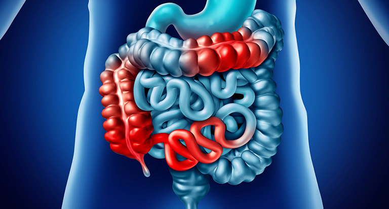 Tìm hiểu về bệnh Crohn