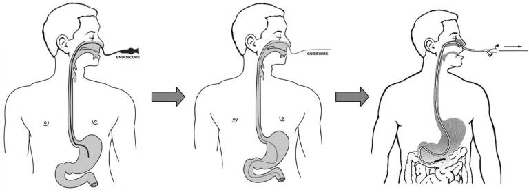Nội soi dạ dày bằng đường mũi