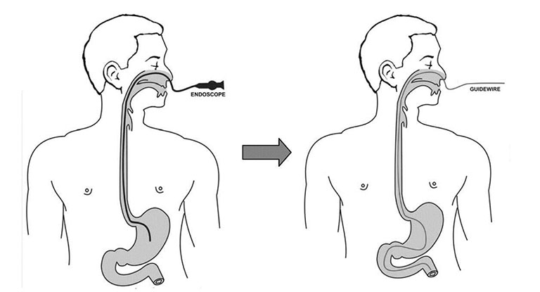 phương pháp nội soi thông thường