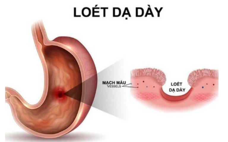 Viêm loét dạ dày tá tràng là một chứng bệnh điển hình của đau dạ dày