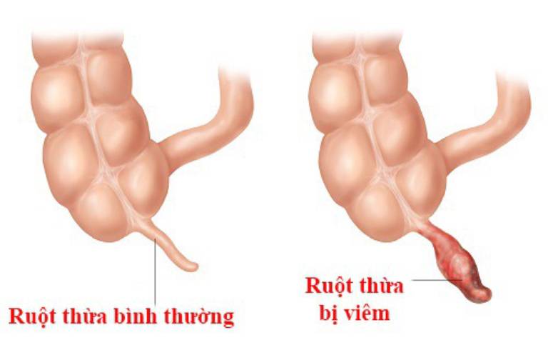 Viêm ruột thừa