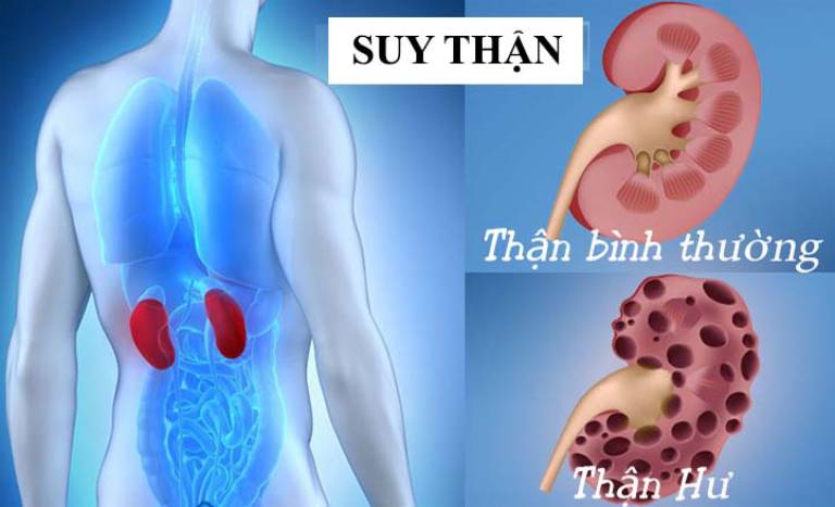 suy thận cấp độ 1 có chữa được không