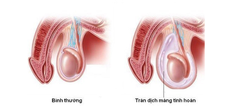 tràn dịch tinh hoàn là gì