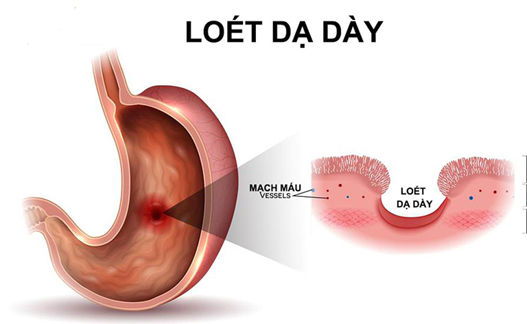 trào ngược dịch mật