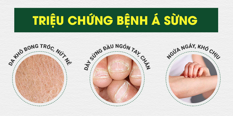 Triệu chứng bệnh á sừng