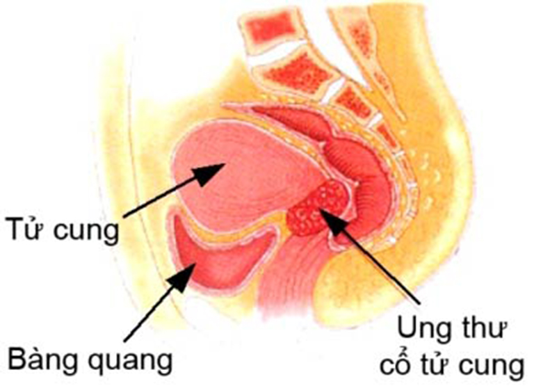 Nguyên nhân gây ra cường kinh ở phụ nữ