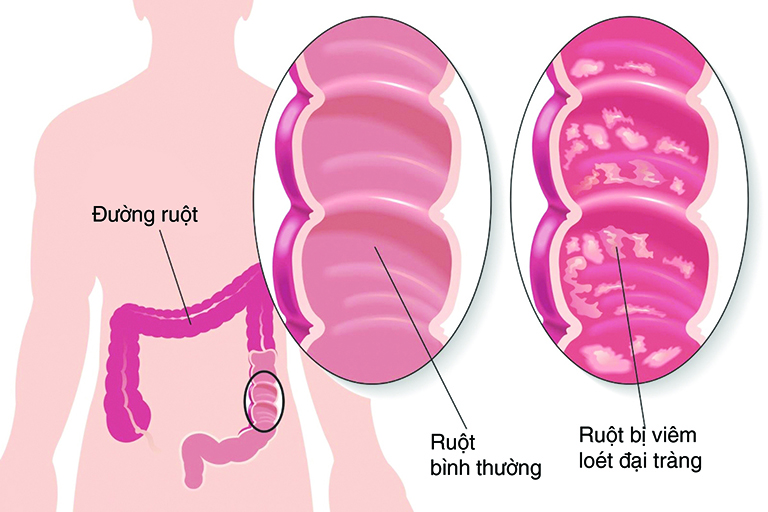 Nguyên nhân gây bệnh viêm ruột thừa cấp