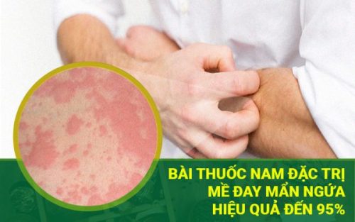 Bài thuốc Tiêu ban Giải độc thang đặc trị mề đay