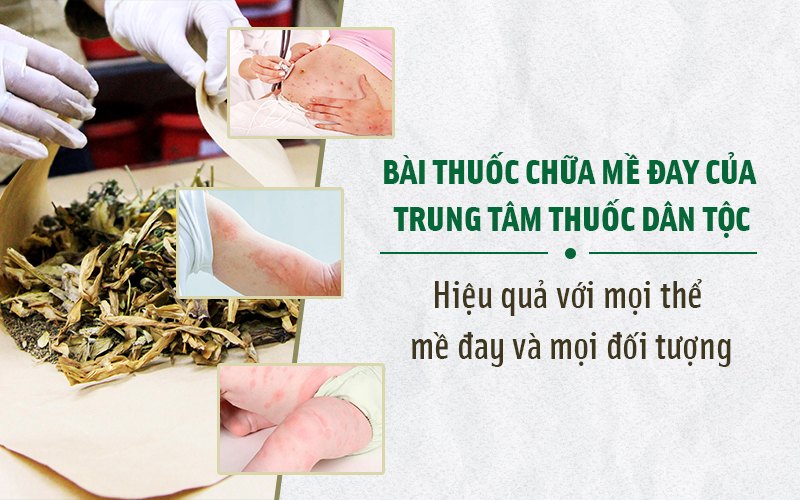 Tiêu ban Giải độc thang đặc trị mọi thể mề đay, dị ứng