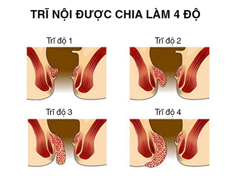 các cấp độ của trĩ nội