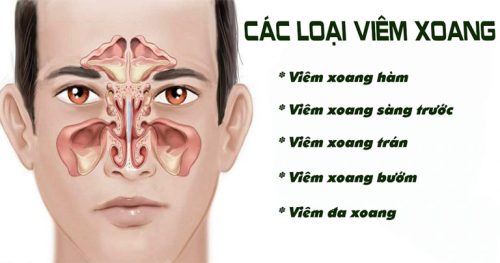 các loại viêm xoang