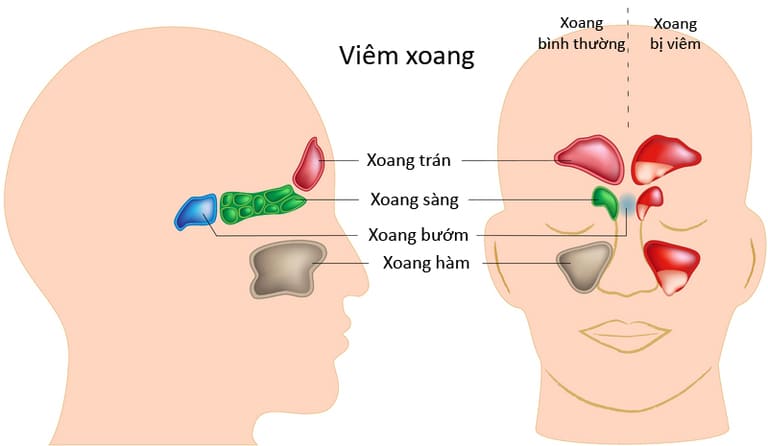 6 cách trị viêm xoang sàng trước và sau tại nhà