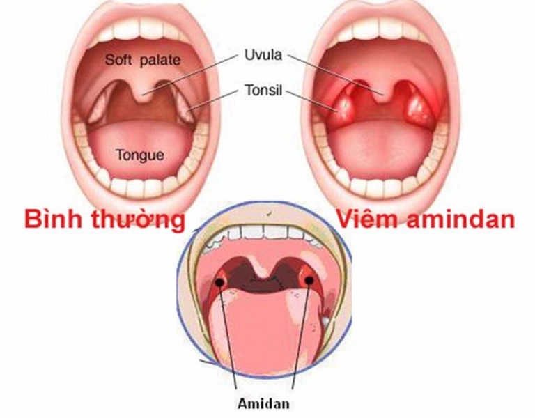 chữa viêm amidan bằng diện chẩn