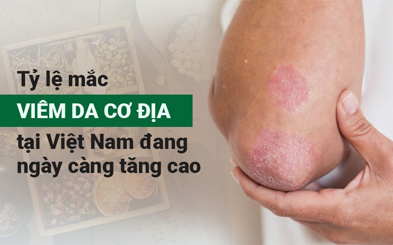 Điều trị viêm da cơ địa tại Trung tâm Thuốc Dân Tộc