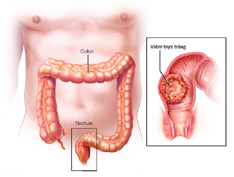 Hậu môn trực tràng là gì?