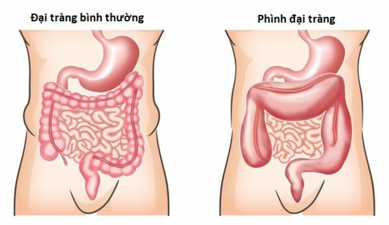 Phình đại tràng bẩm sinh là nguyên nhân khiến trẻ sơ sinh 2 ngày không đi ngoài được