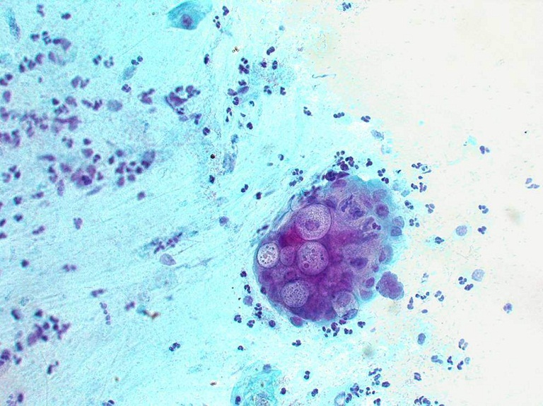 Bệnh Chlamydia ở nam giới