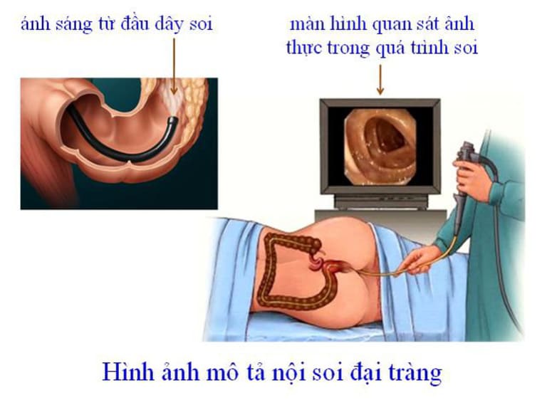 Hình ảnh nội soi đại tràng