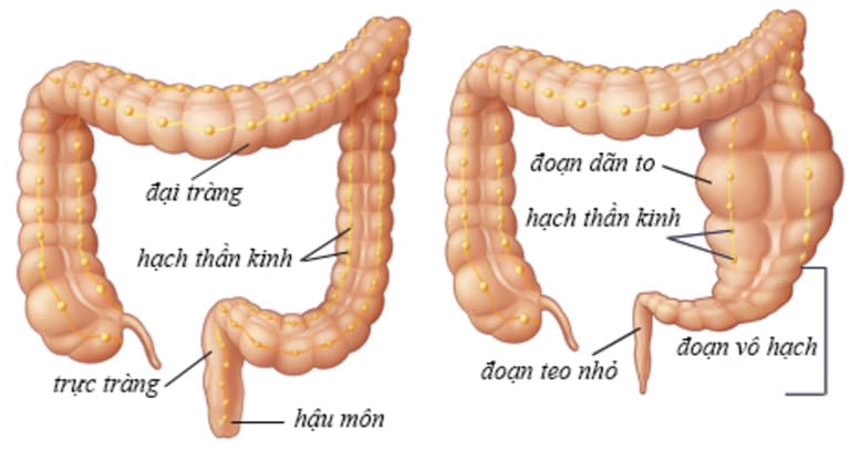 trẻ sơ sinh bị táo bón lâu ngày là bệnh gì