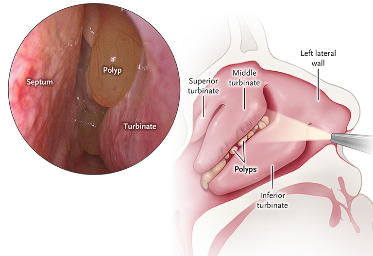 Một số hình ảnh của polyp xoang hàm