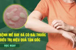 Tiêu ban Giải độc thang - Giải pháp "vàng" cho bệnh nhân mề đay mẩn ngứa