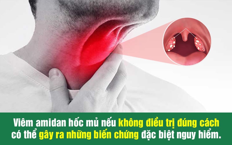 Viêm amidan hốc mủ không thể coi thường