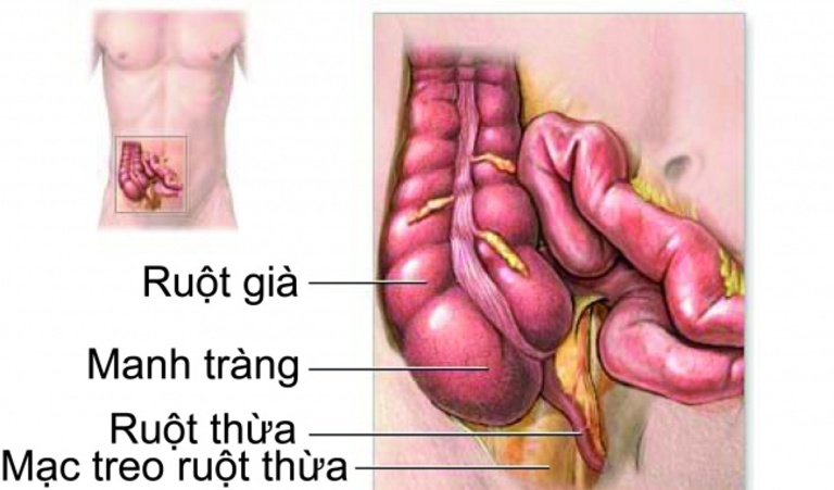 Viêm đại tràng co thắt 