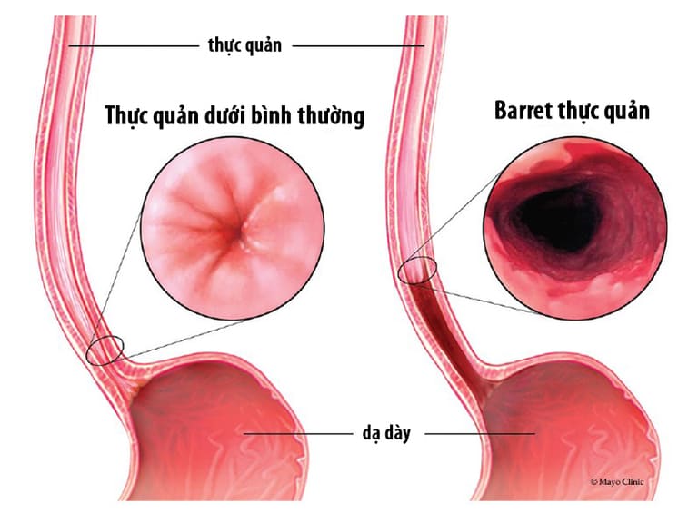 Đại tiện ra máu hoặc phân có màu đen