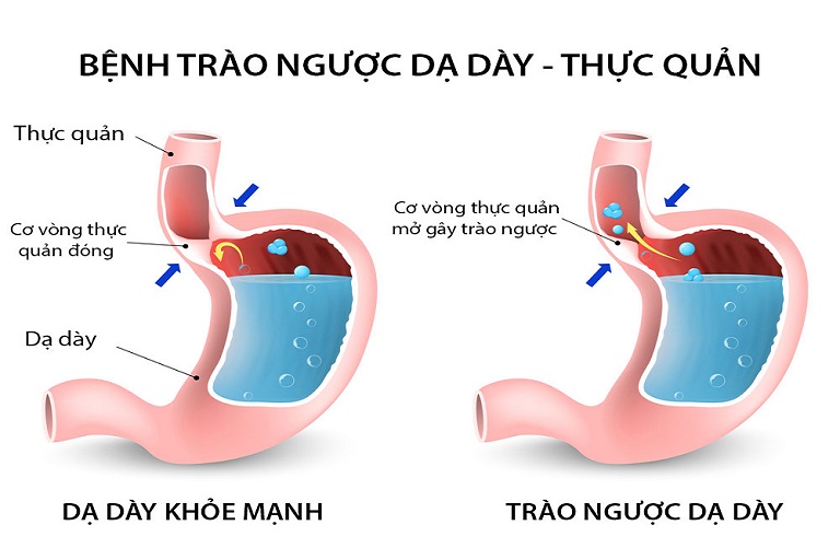 trào ngược dạ dày thực quản