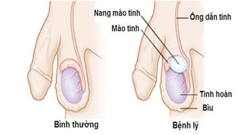 nang mào tinh hoàn là bệnh gì