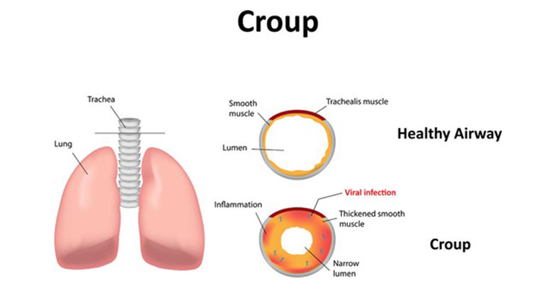 viêm thanh khí phế quản ở trẻ em