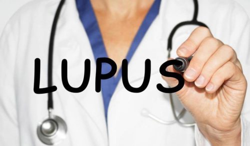 bệnh lupus ban đỏ có chữa được không?