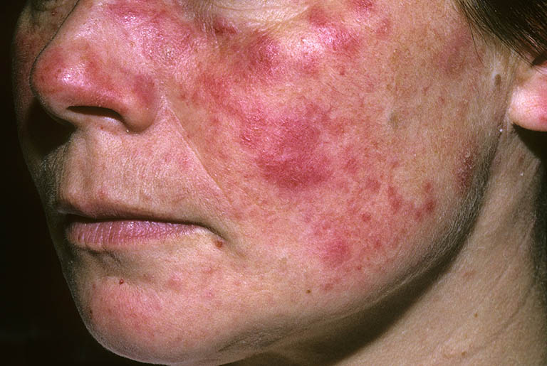 lupus ban đỏ hệ thống bệnh học