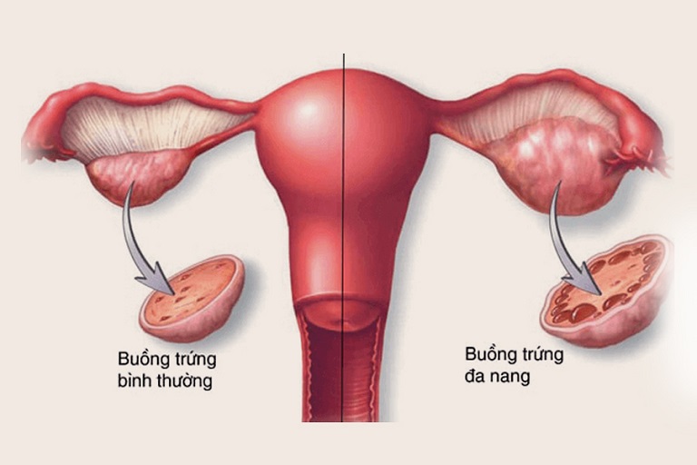 buồng trứng bình thường có bao nhiêu nang