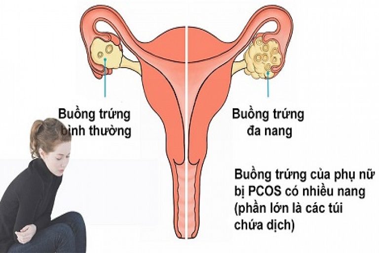 người bị đa nang buồng trứng không nên an gì