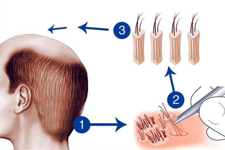 cấy tóc chữa rụng tóc ở tuổi dậy thì