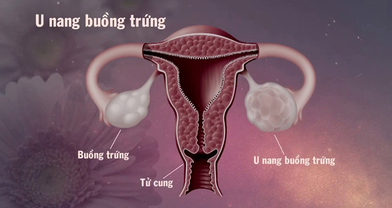 Nang cơ năng buồng trứng