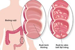 Hình ảnh viêm loét đại tràng