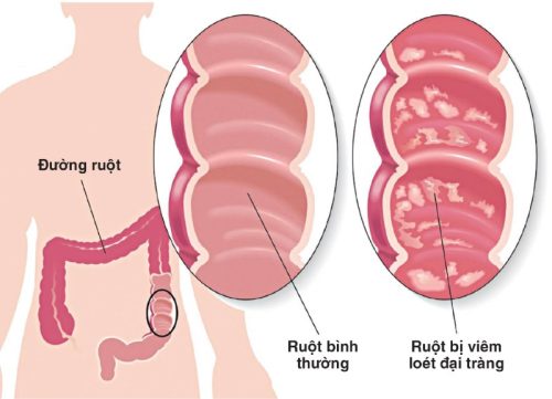 Hình ảnh viêm loét đại tràng