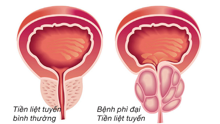 sỏi bàng quang có nguy hiểm không