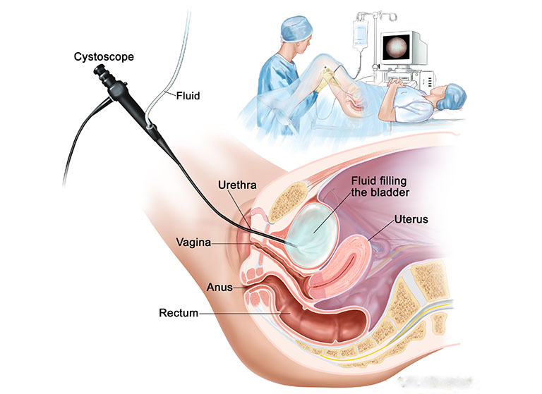 tán sỏi bàng quang bằng laser