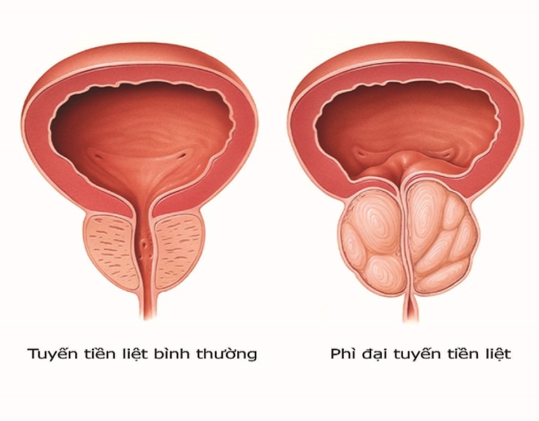 đau xương chậu ở nam giới