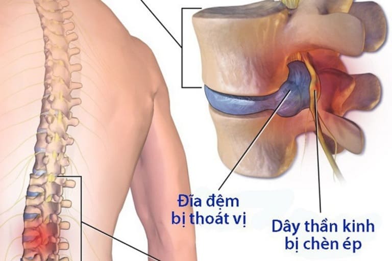 Bị đau xương cụt do bệnh thoát vị đĩa đệm