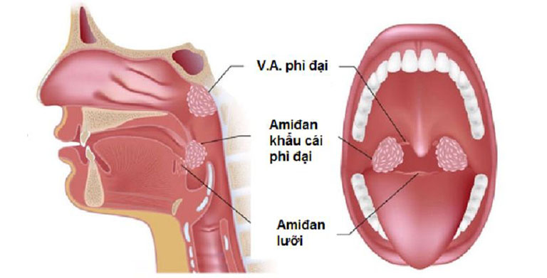 viêm amidan lưỡi