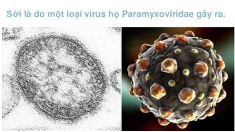 Virus Polynosa morbillorum là tác nhân chính gây ra bệnh sởi