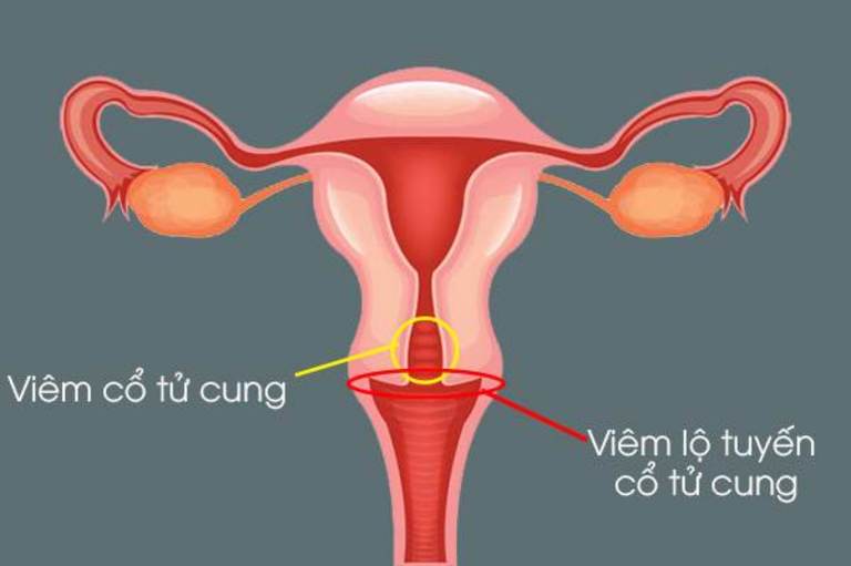 bệnh viêm cổ tử cung