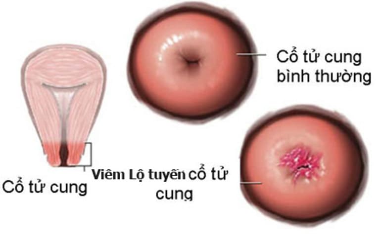 Cổ tử cung là gì