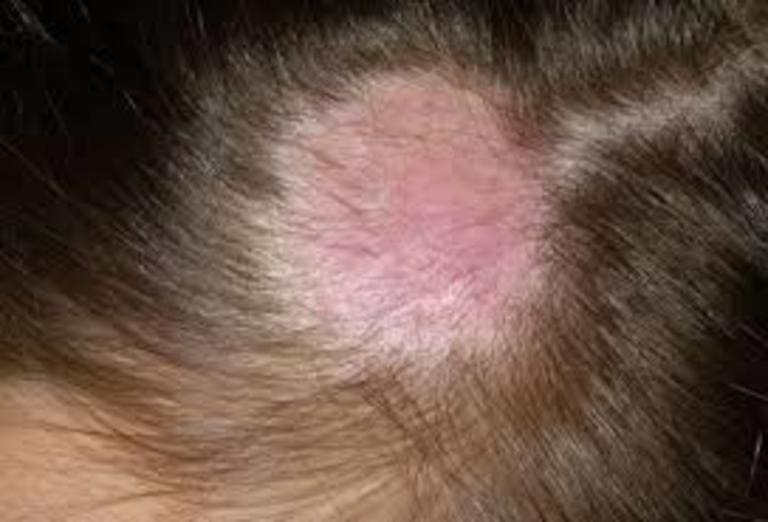  những hình ảnh của bệnh hắc lào ở da đầu
